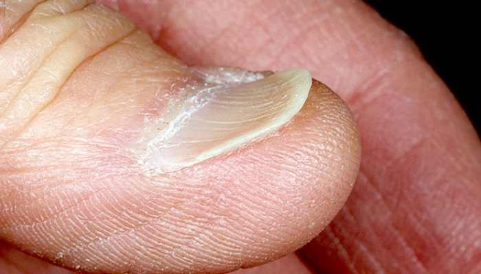 Ложкообразные ногти: причины и лечение