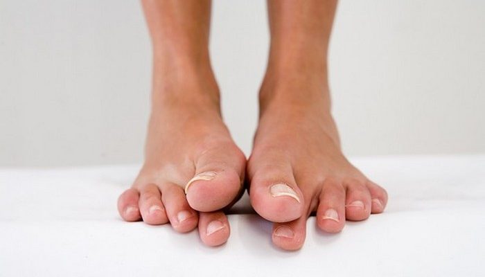 Как формируется вросший ноготь на большом пальце ноги? Способы лечения