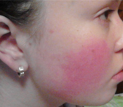 Аллергия на щеках у взрослого лечение thumbnail