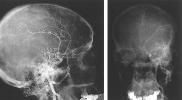 Каротидные ангиограммы больного с узловой менингиомой крыльев клиновидной кости с краниоорбитальным распространением
