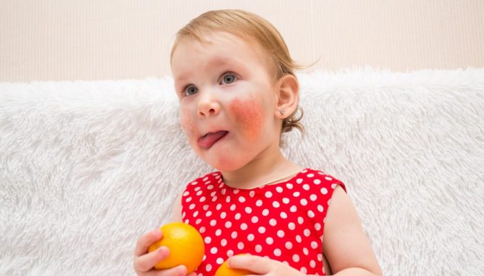 Как проявляется и лечится аллергия на мандарины? Отвечаем на популярные вопросы