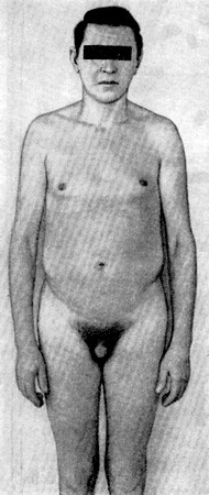 Фото синдрома Клайнфельтера: penis небольшой, мошонка маленькая