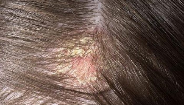 Почему появились болячки в волосах на голове? Основные причины и лечение у взрослых и детей