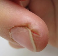 Как лечить трещины на пальце около ногтя