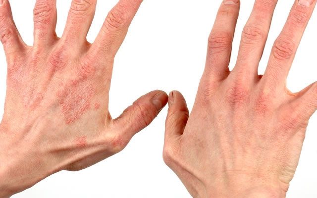 Аллергия и другие побочные эффекты Джес Плюс: как избежать неприятных явлений?