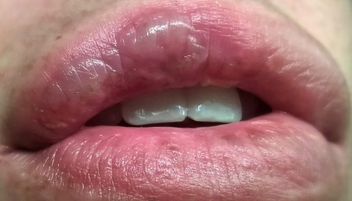 Ожог на губе: чем лечить и что делать?