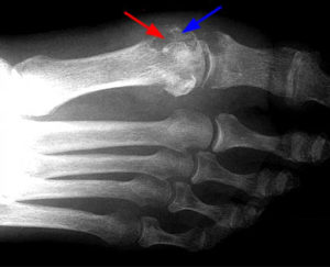 Подагрический артрит на рентгене
