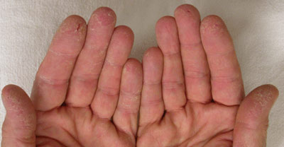 Почему трескается кожа на пальцах рук?