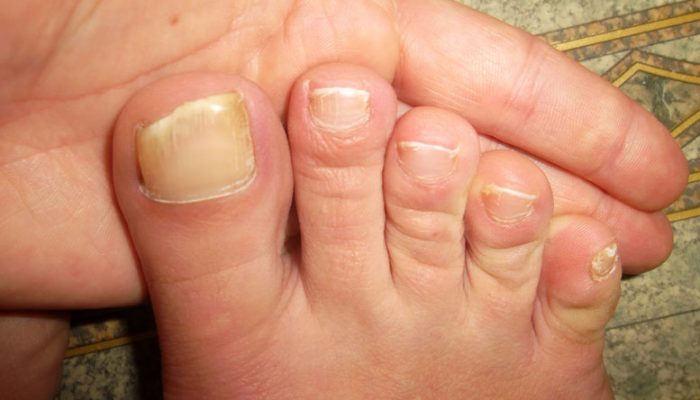 Как легко распознать и лечить грибок ногтей у ребенка? Советы специалистов