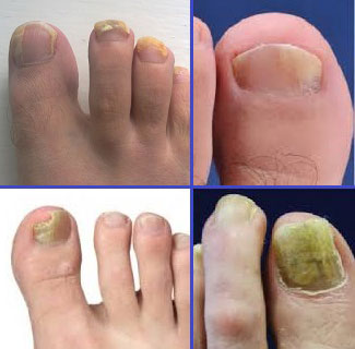 Причины дерматофитов ногтей на ногах