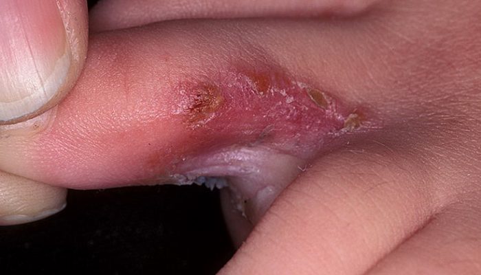 Покраснение между пальцами рук: фото, причины, возбудители, осложнения, диагностика и лечение зуда и шелушения кожи, профилактические меры