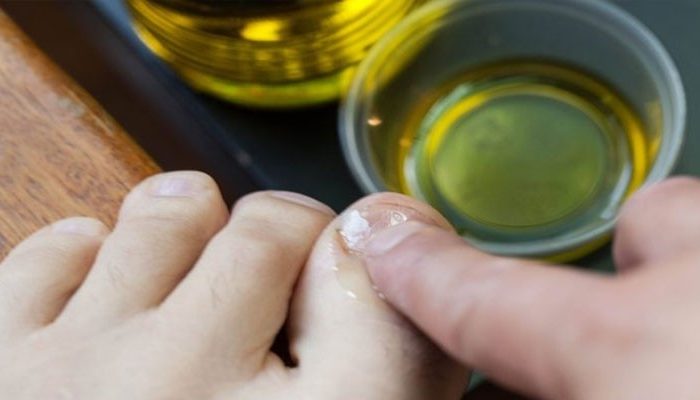 Можно ли использовать нашатырный спирт от грибка ногтей? Рецепты