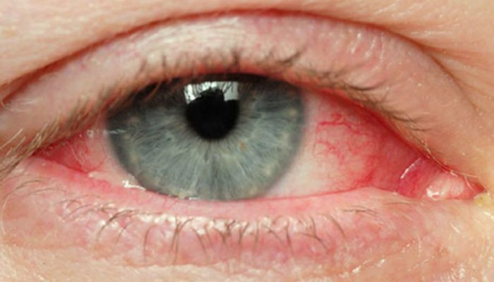 Основные симптомы и тактика лечения хламидиоза глаз