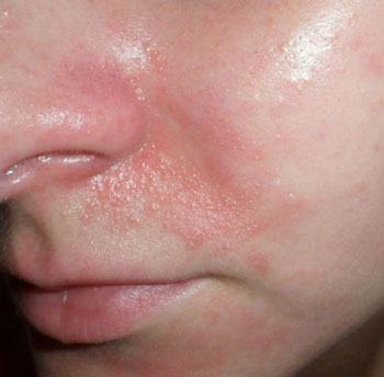 Сыпь и шелушение кожи на лице вокруг носа thumbnail