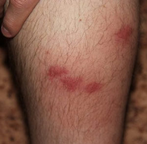Красные шелушащиеся пятна на ногах появляются из-за аллергена