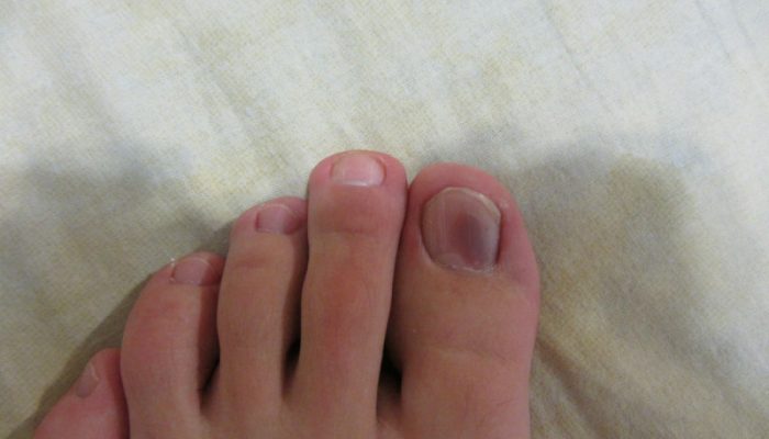 Как лечить синяк под ногтем большого пальца ноги? Можно ли прокалывать? Правильная терапия