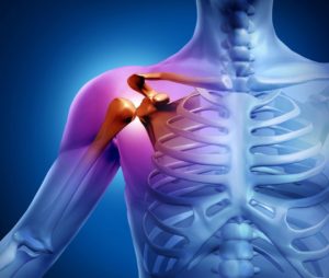 Артрит плечевого сустава: типы заболевания