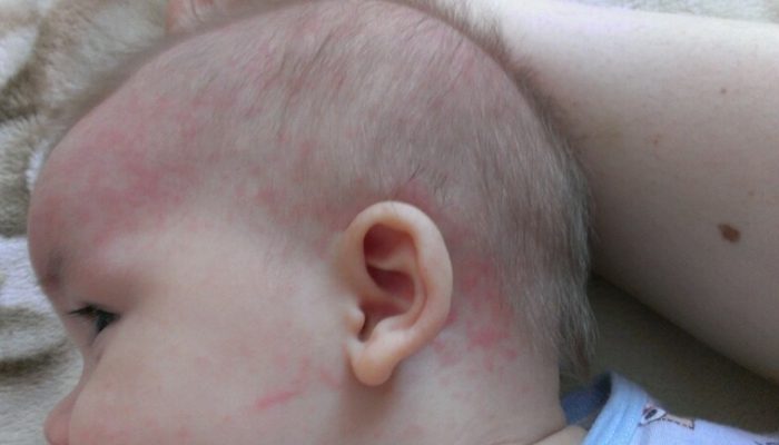 Сыпь на ушах у ребенка и взрослого: причины