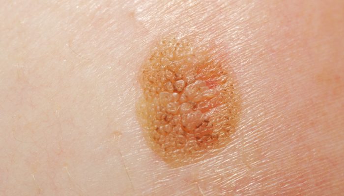 Как проявляется и лечится меланома кожи? Своевременная диагностика опасной болезни