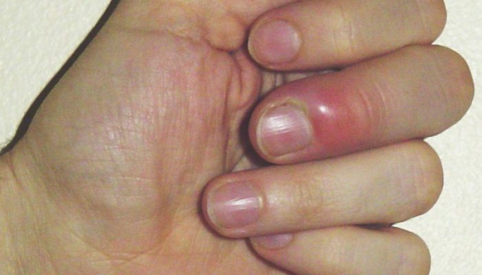 Заболевания ногтей на руках и их лечение