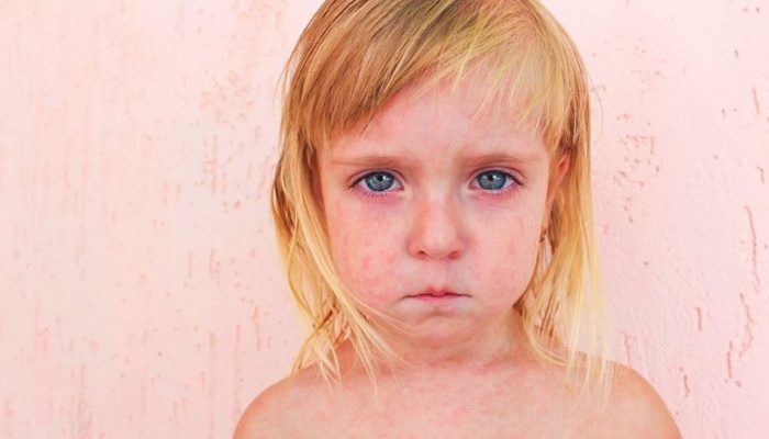 Что такое розеола у детей: причины симптомы лечение и советы Комаровского