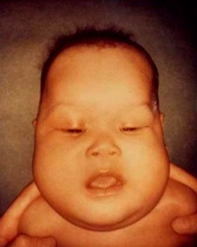 Фото больного младенческим кортикальным гиперостозом