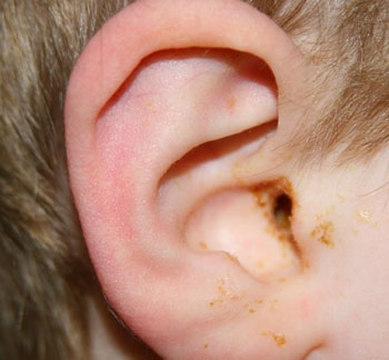 Почему уши чешутся внутри и чем лечить зуд в них
