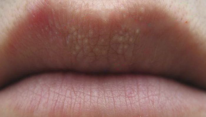 Как выглядят гранулы Фордайса на губах и половых органах? Следует ли их лечить?
