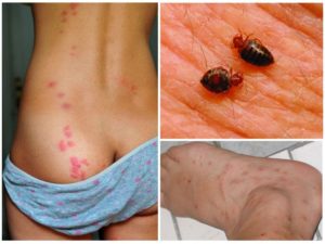 укус клопа на теле человека - как выглядят следы, аллергия, чем обработать, в чем опасность?