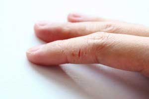 Почему лопается кожа на пальцах рук?