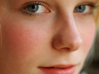 Покраснение на щеках у взрослого аллергия thumbnail