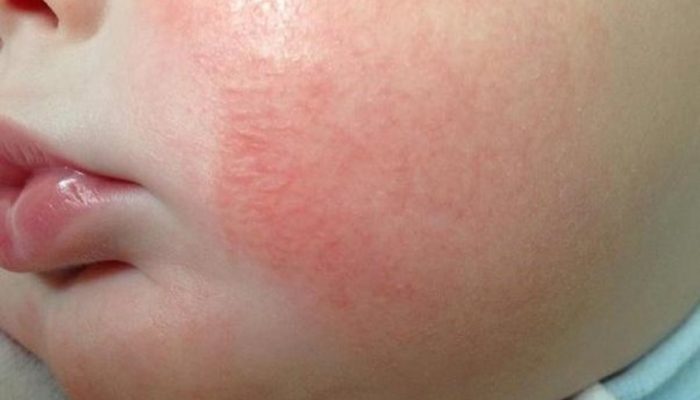 Как отличить сыпь при дисбактериозе у взрослого и ребенка от аллергии и правильно ее лечить?