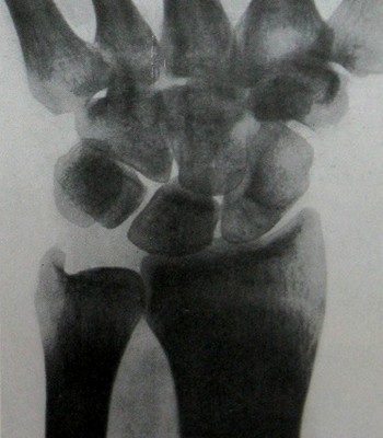 Снимок ладьевидной кости после 3,5-месячной иммобилизации