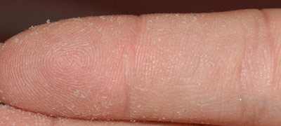 Причины, по которым облазит кожа на подушечках пальцев рук.