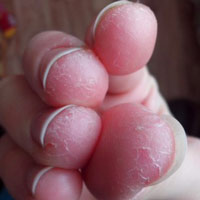 Причины сухой кожи на одном пальце руки thumbnail