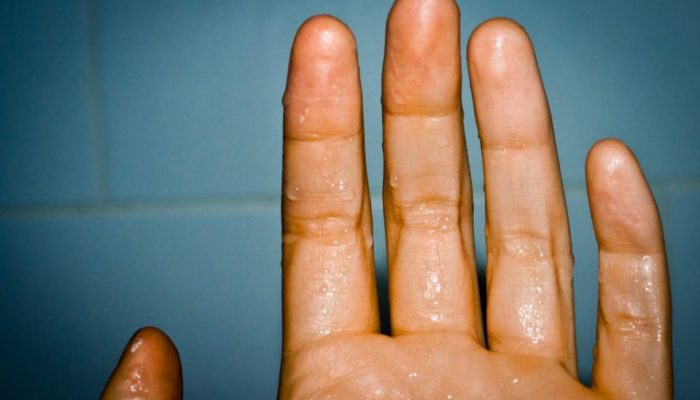 Повышенная потливость рук и ног: причины и лечение