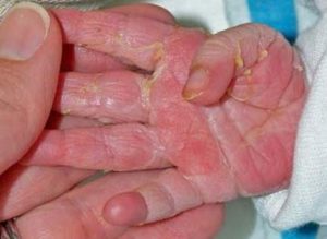 Когда слезает кожа на пальцах рук у ребёнка
