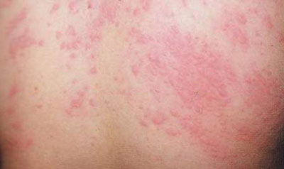 Проявления аллергии в виде красных пятен на коже спины