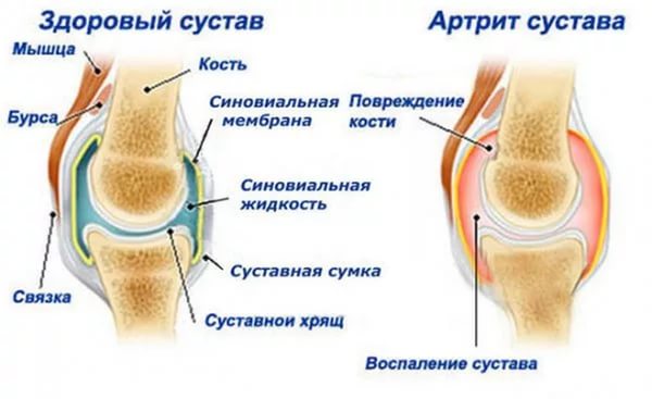 лечение артрита