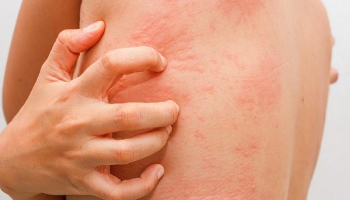Чем отличается непереносимость и аллергия на лактозу? Каковы симптомы и лечение?