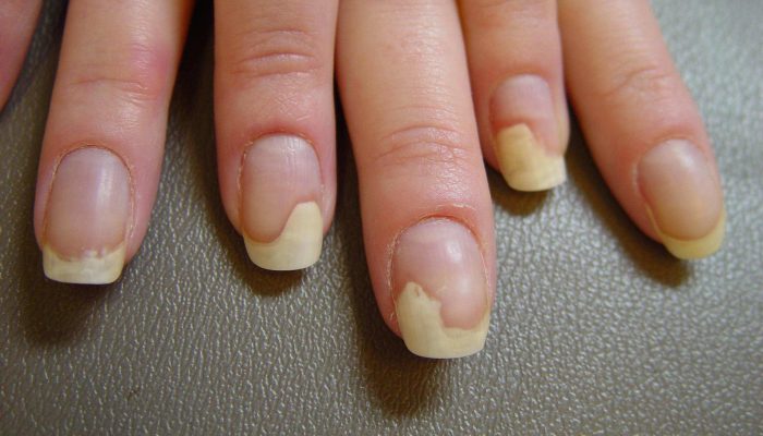 Причины и лечение черных точек, светлых пятен и других изменений на ногтях рук и ног
