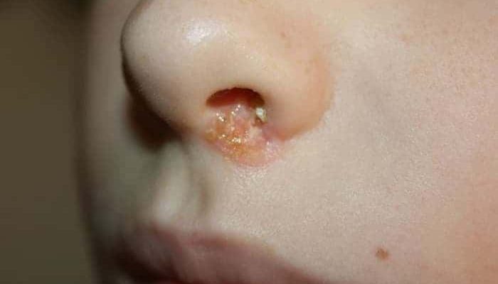 Коросты в носу: причины и чем лечить?