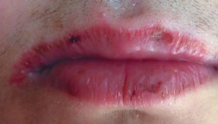 Самые распространенные причины воспаления губ и способы, как быстро лечить хейлит?