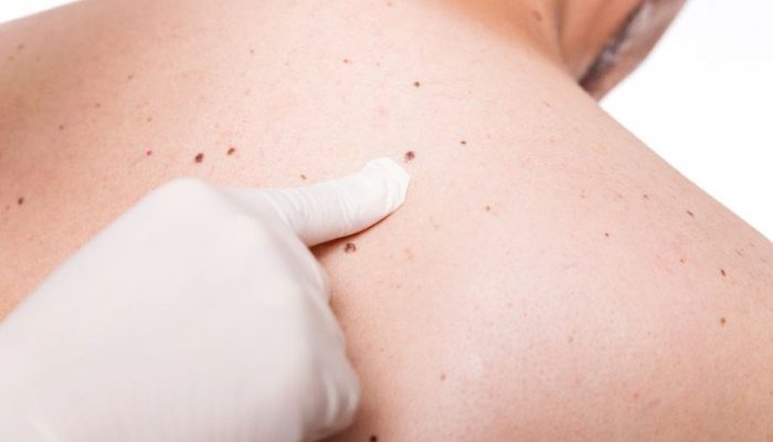 Что такое базалиома кожи? Причины, симптомы и эффективные методы лечения рака