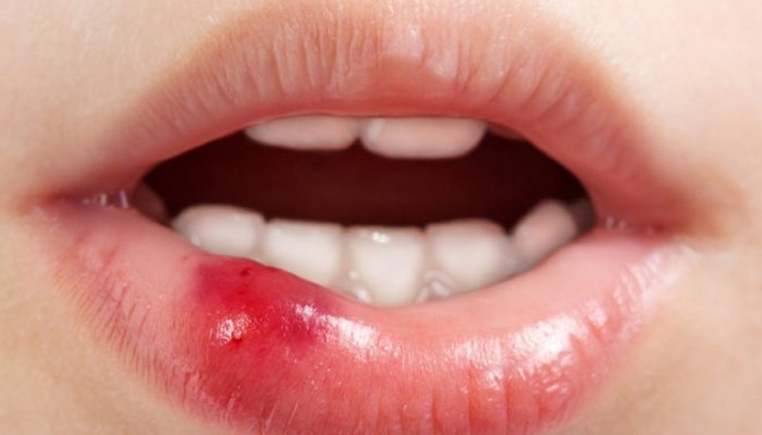 Гнойник, язвочка или болячка на губе? Советы, как быстро избавиться, чем лечить, а также что делать, если долго не заживает
