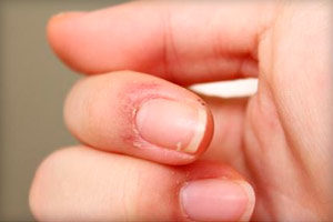 Почему сохнет и трескается кожа на пальцах рук около ногтей - способы избавления от пробелмы
