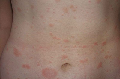 Красные пятна на коже зачастую являются результатом аллергических реакций