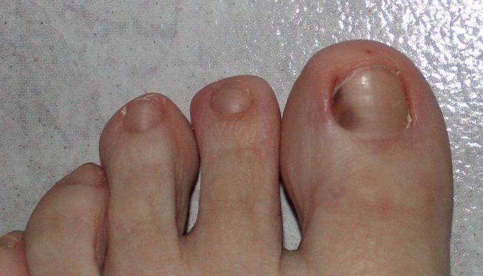 Как лечить синяк под ногтем большого пальца ноги? Можно ли прокалывать? Правильная терапия