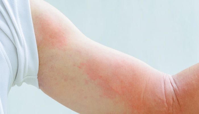 Почему чешется кожа после душа? Подробно об аквагенном зуде, аллергии на воду и крапивнице