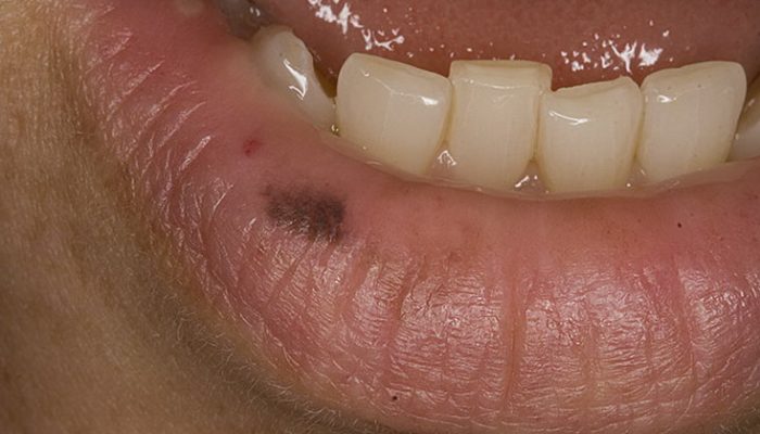 Что означает появление черного, синего или красного пятна на губе? Распространенные причины пигментации